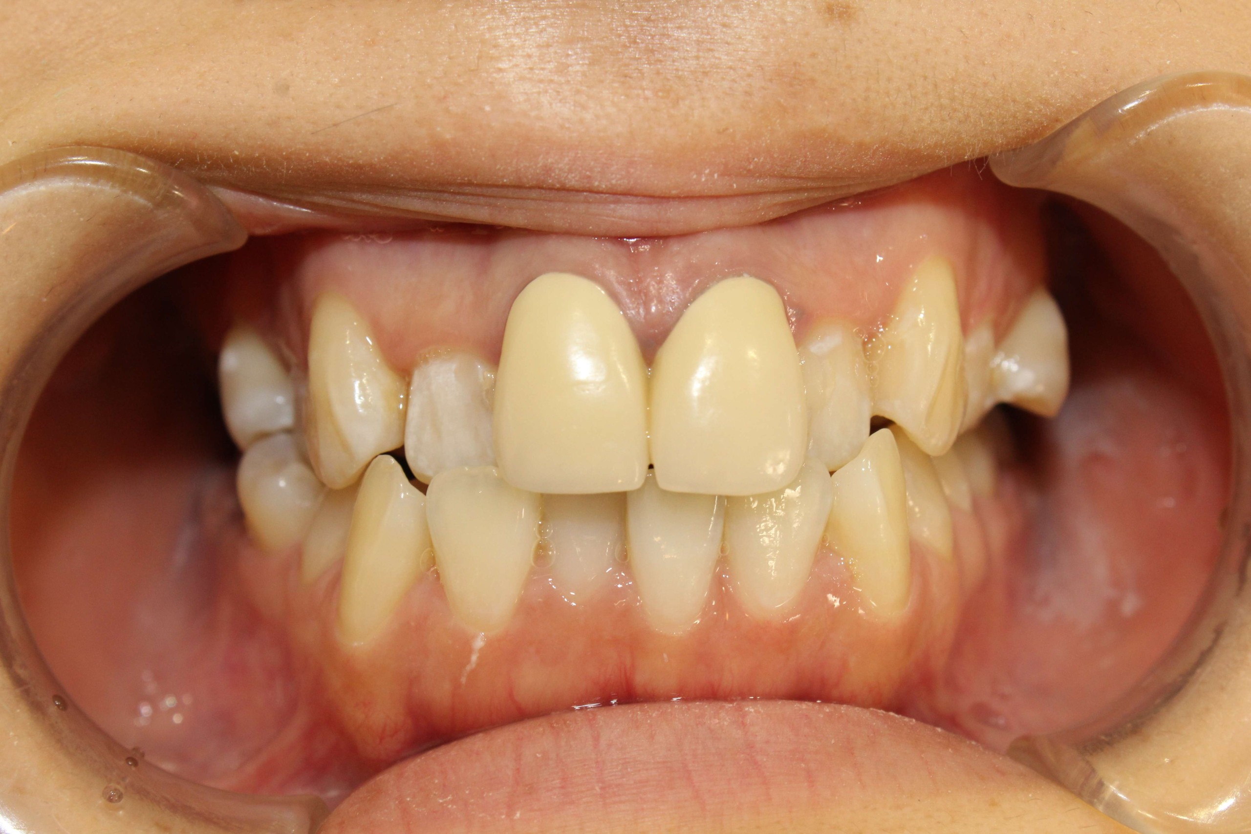 でこぼこ・リンガルの症例