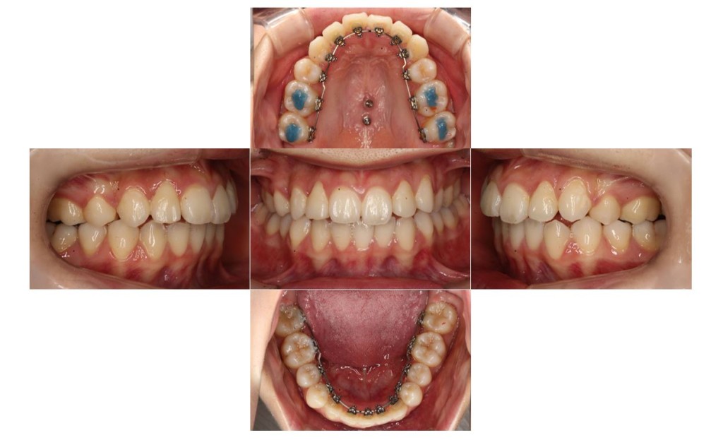 でこぼこ・噛み合わせ改善・リンガルの症例