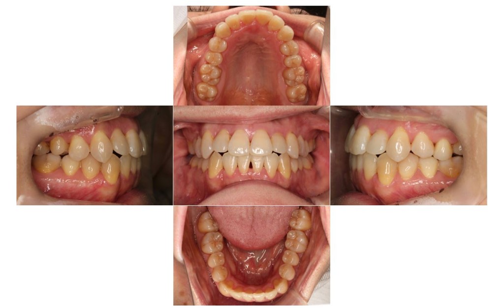 歯の凸凹・リンガルの症例