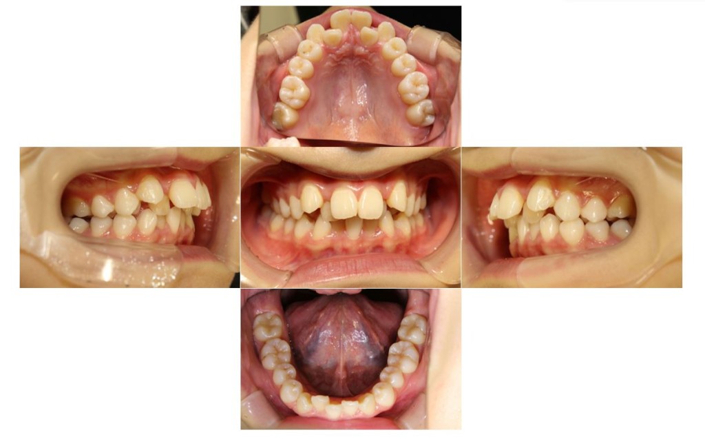 でこぼこ・噛み合わせ改善・リンガルの症例