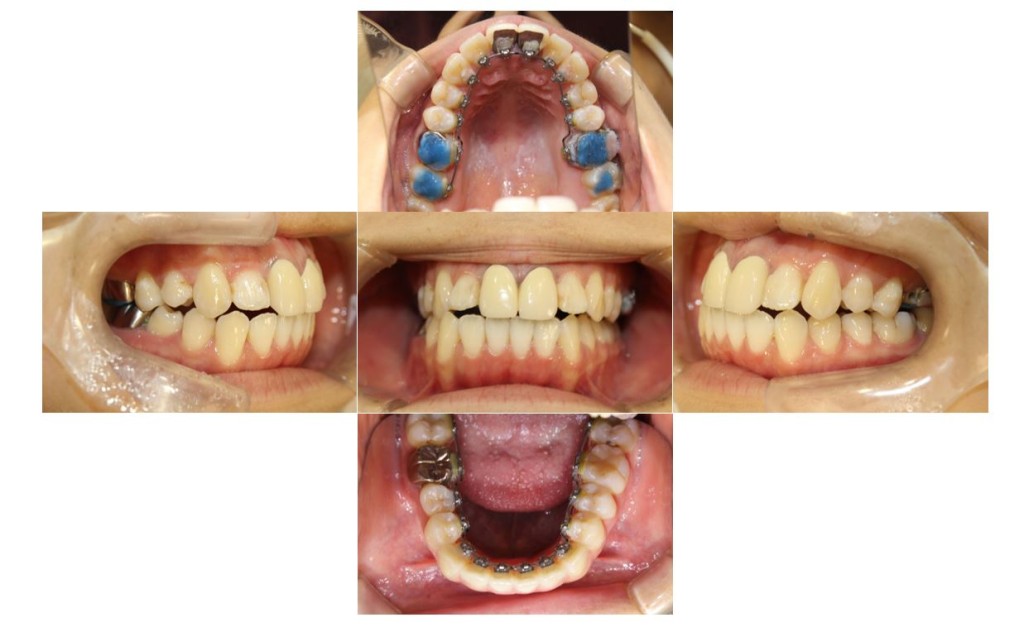 でこぼこ・リンガルの症例