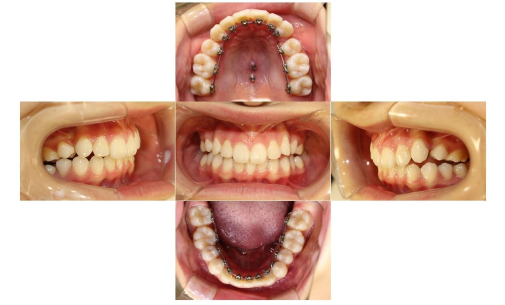 でこぼこ・噛み合わせ改善・リンガルの症例