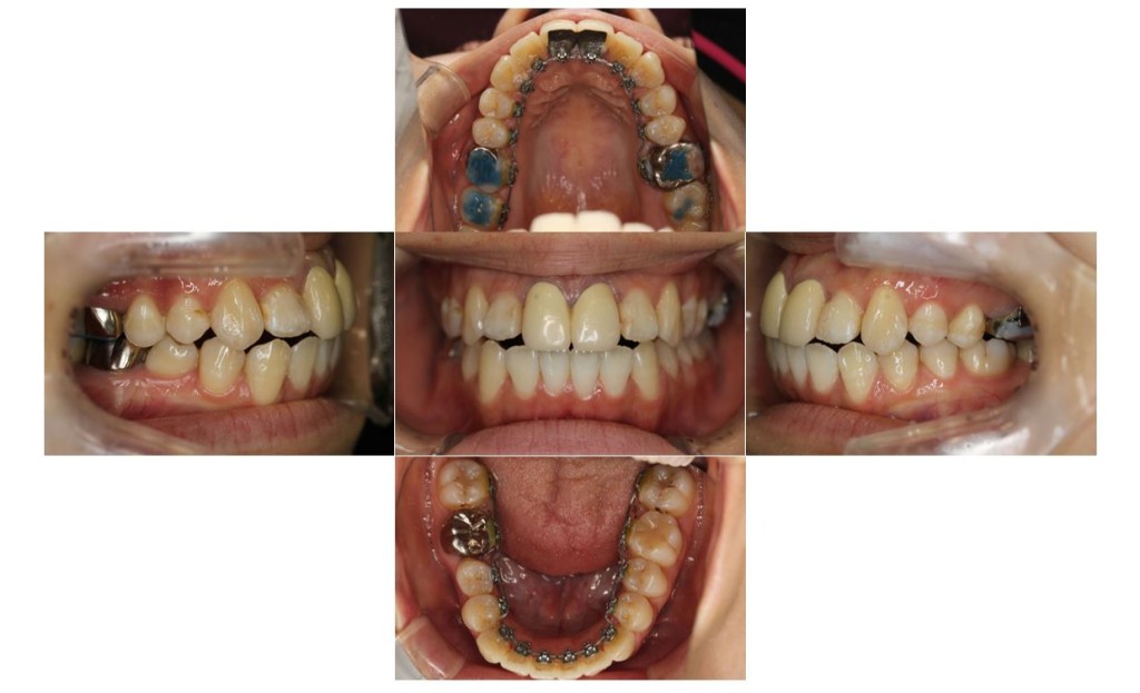 でこぼこ・リンガルの症例