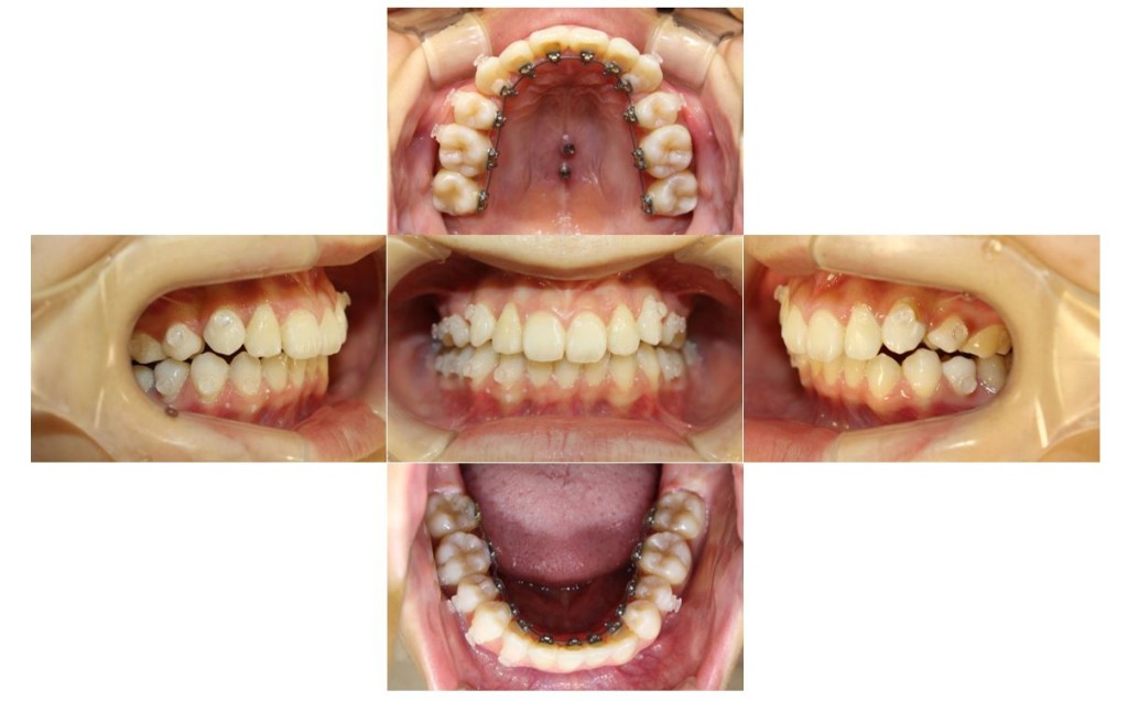 でこぼこ・噛み合わせ改善・リンガルの症例