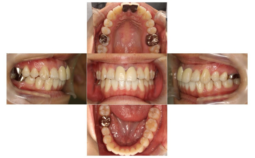 でこぼこ・リンガルの症例