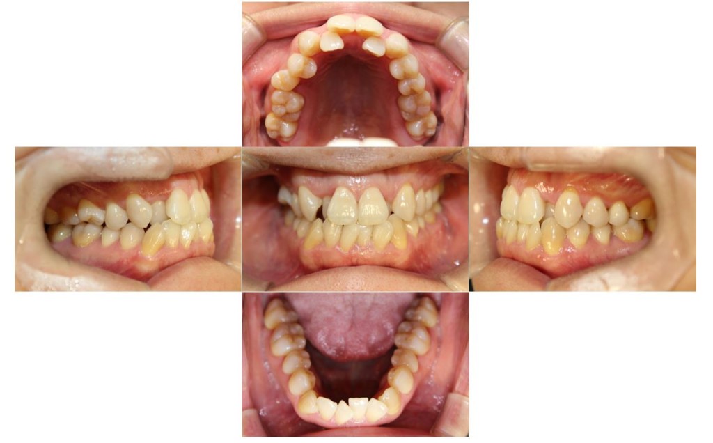 歯の凸凹・リンガルの症例