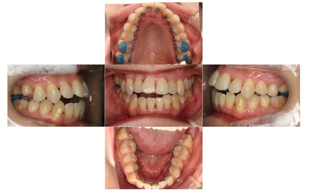 歯の凸凹・リンガルの症例