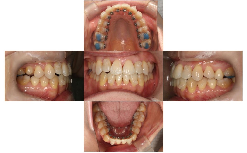 歯の凸凹・リンガルの症例