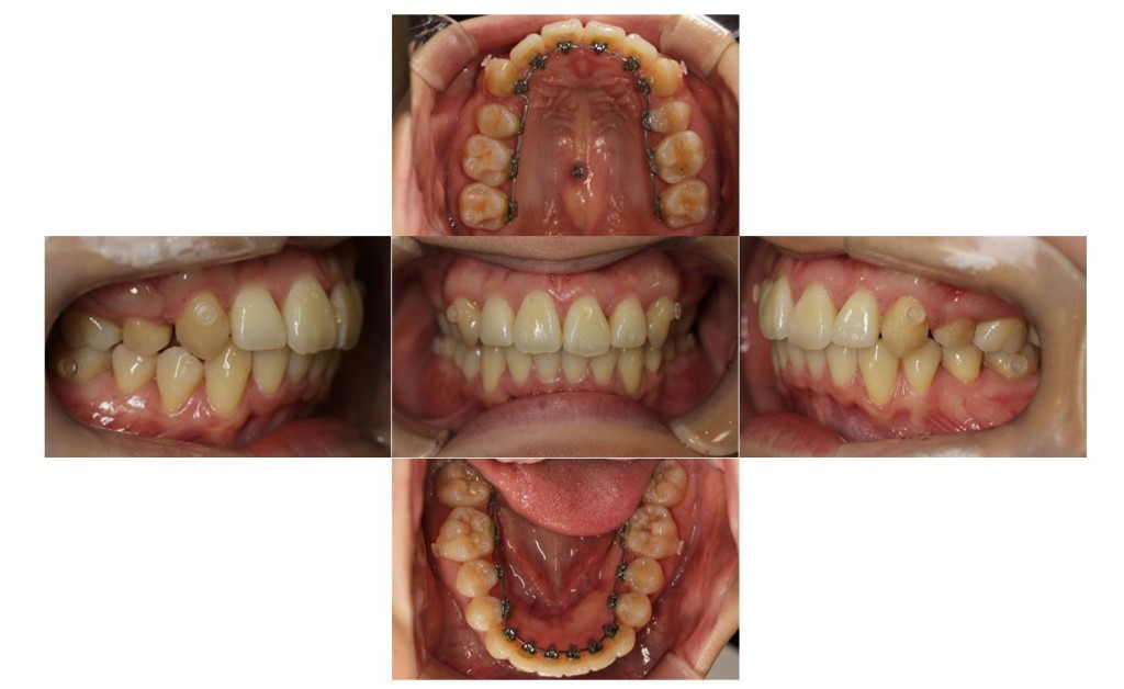 上の歯が出ている・リンガルの症例