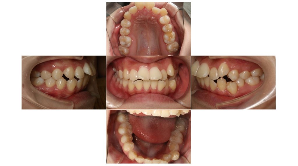 歯のでこぼこ・ハーフリンガルの症例