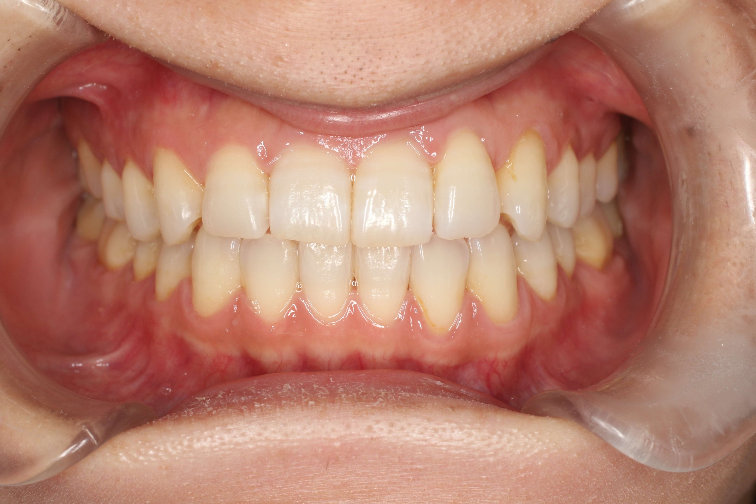 噛み合わせ・リンガルの症例