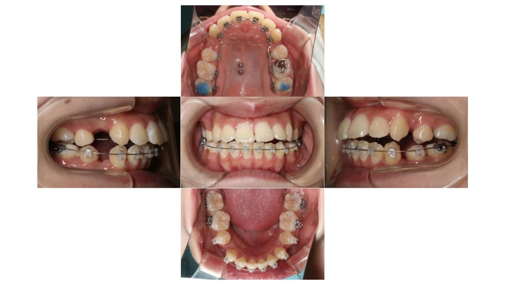 歯のでこぼこ・ハーフリンガルの症例