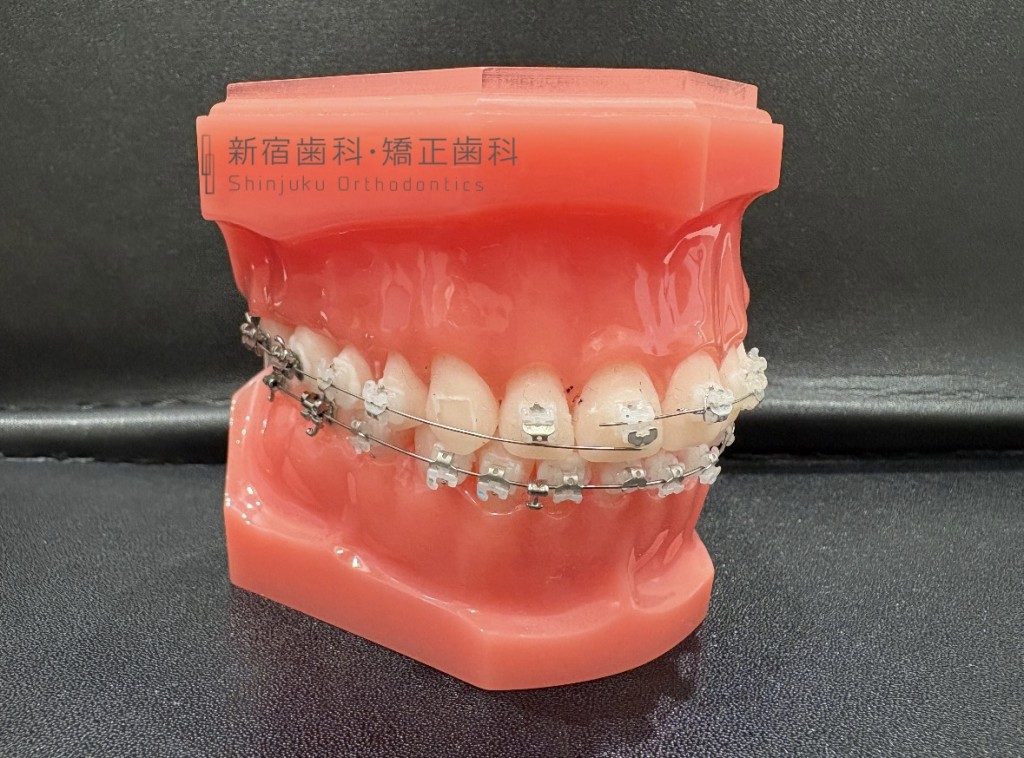 歯列矯正中のトラブルについて 矯正中に矯正装置を飲み込んでしまうことあるのか