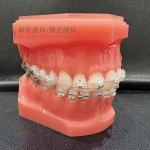 歯列矯正中のトラブルについて　矯正中に矯正装置を飲み込んでしまうことあるのか