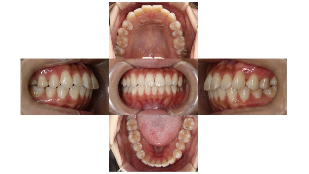 口元を下げたい・ハーフリンガルの症例