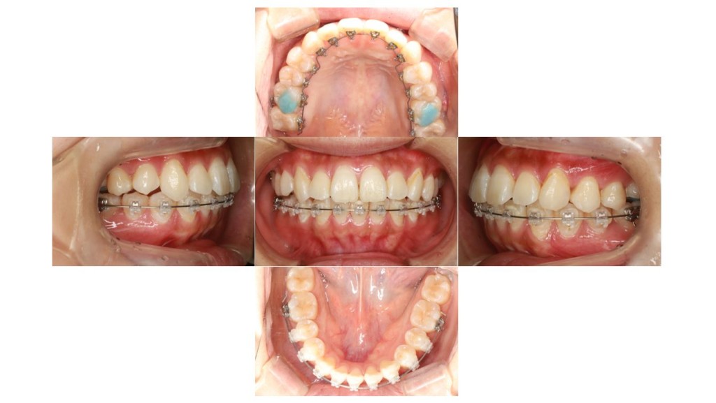 口元を下げたい・ハーフリンガルの症例