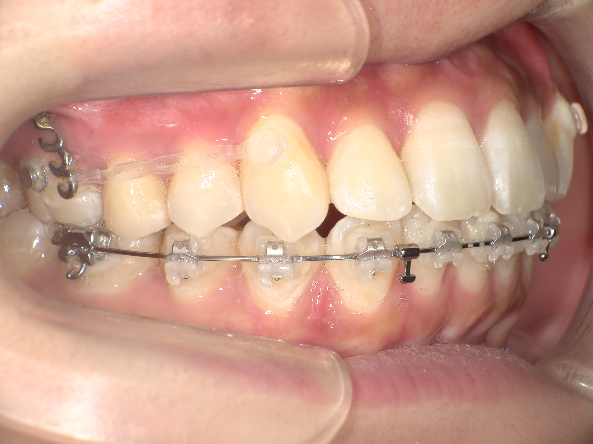 口元を下げたい・ハーフリンガルの症例