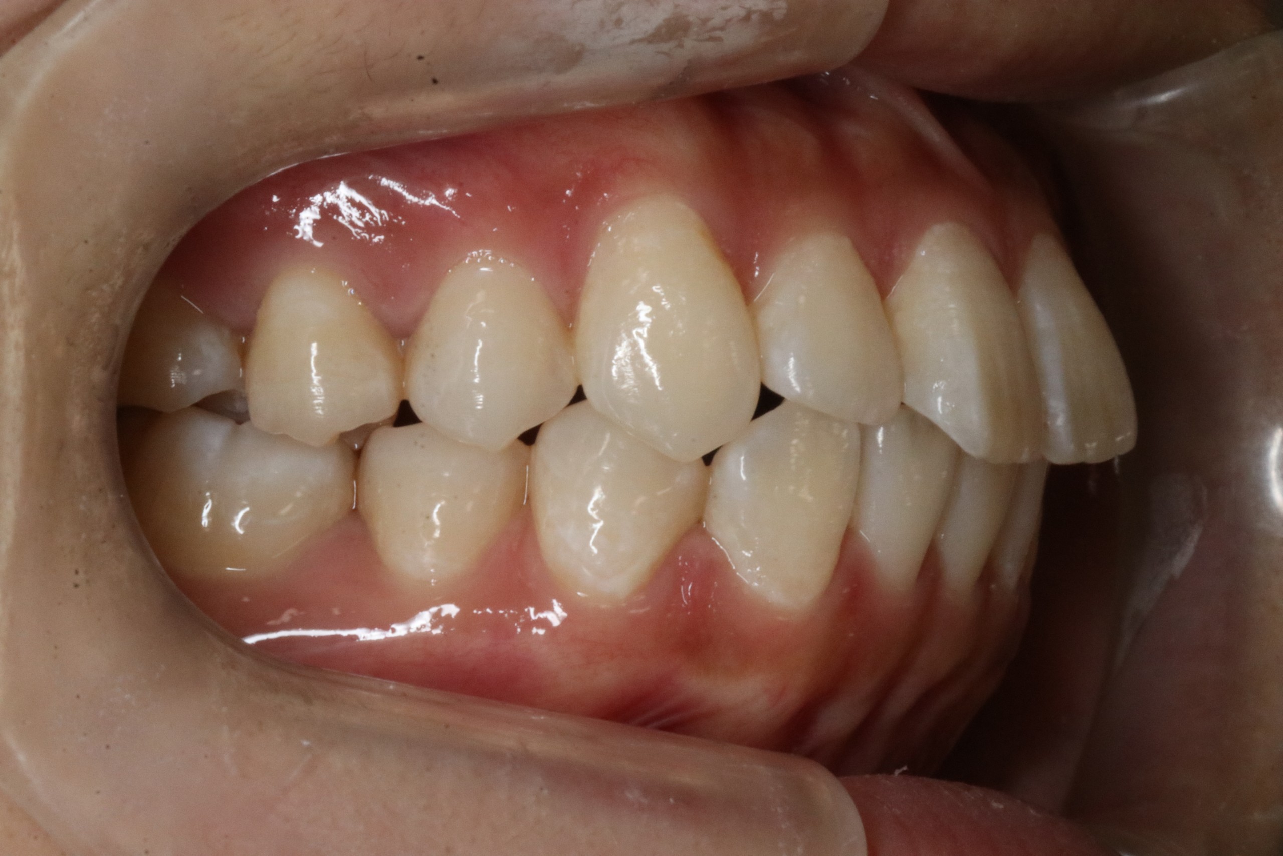 口元を下げたい・ハーフリンガルの症例