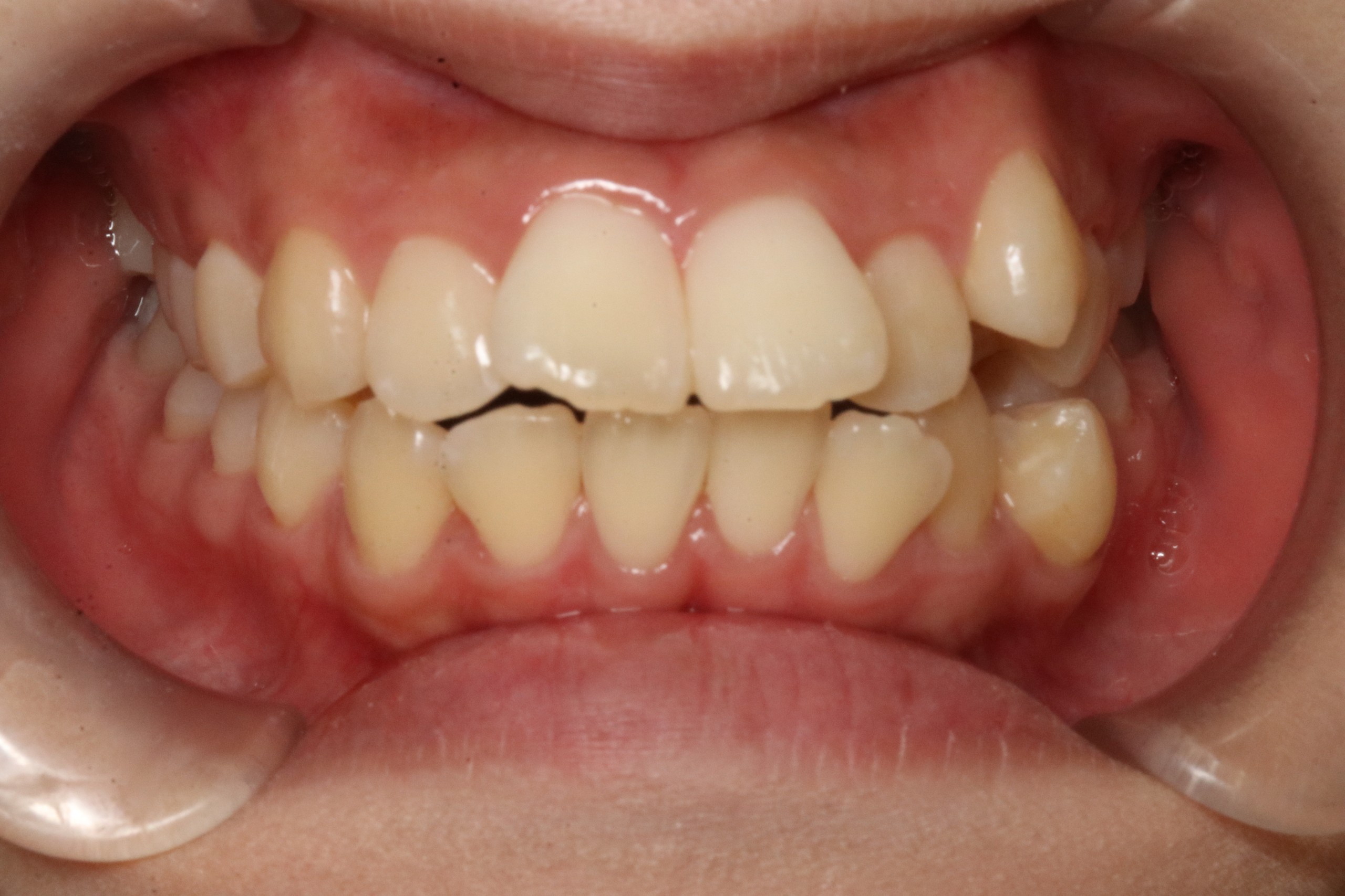 歯のでこぼこ・ハーフリンガルの症例