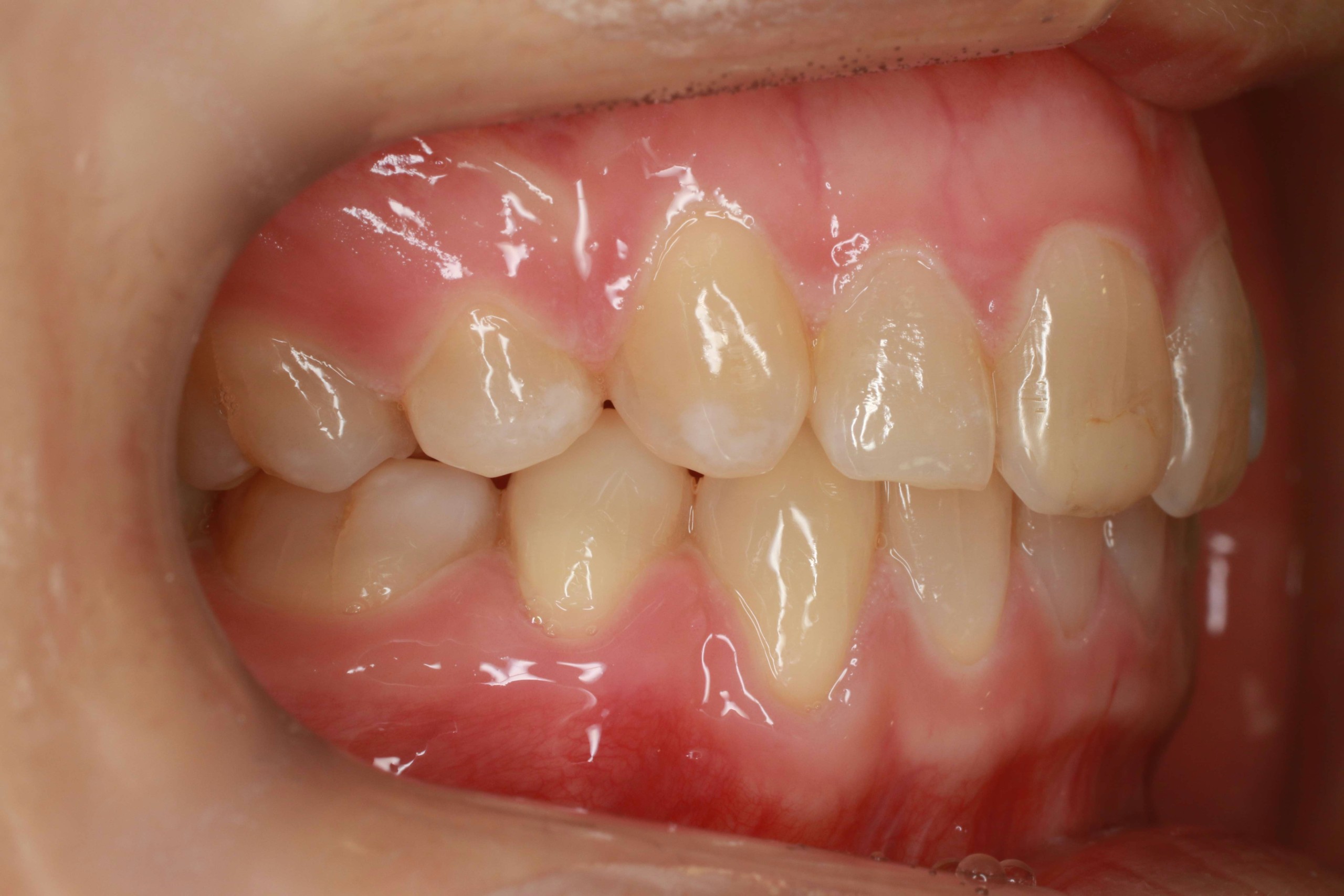 上の歯が出ている・リンガルの症例