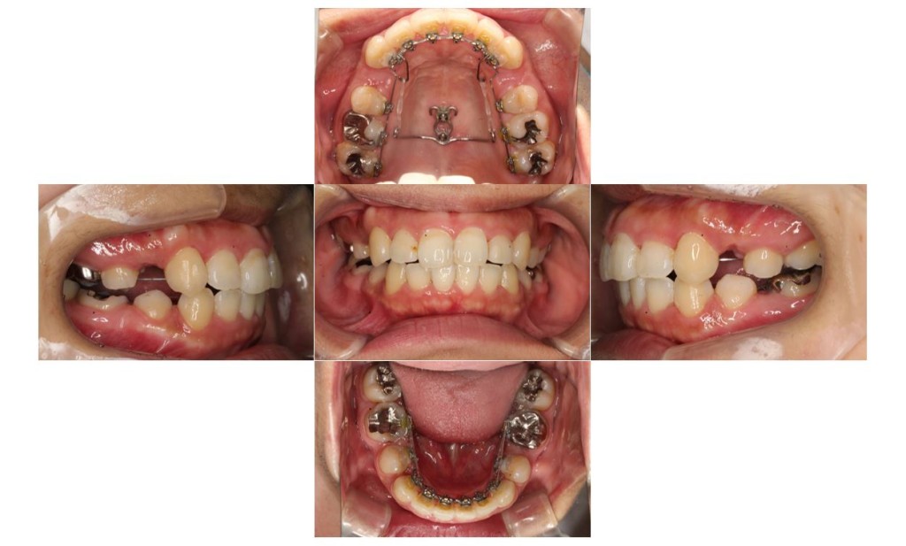 でこぼこ・リンガルの症例