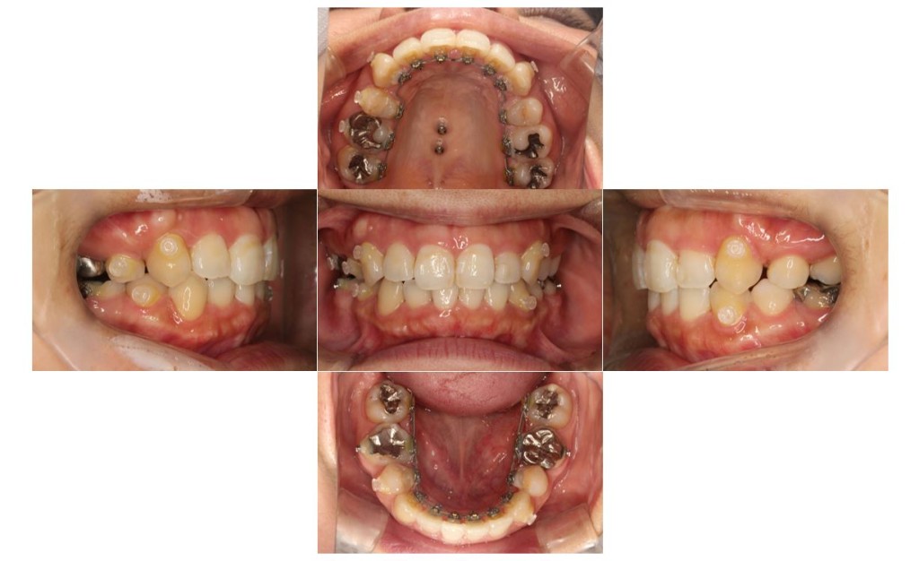 でこぼこ・リンガルの症例