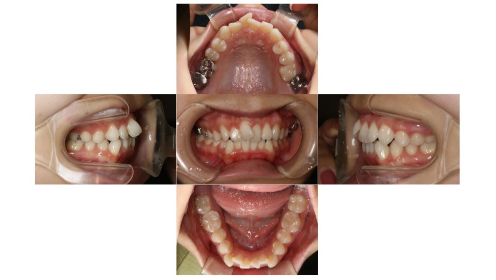 上の歯が出ている・ハーフリンガル矯正の症例