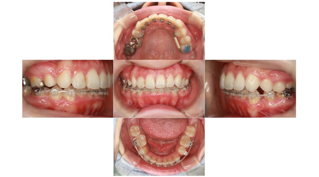 上の歯が出ている・ハーフリンガル矯正の症例