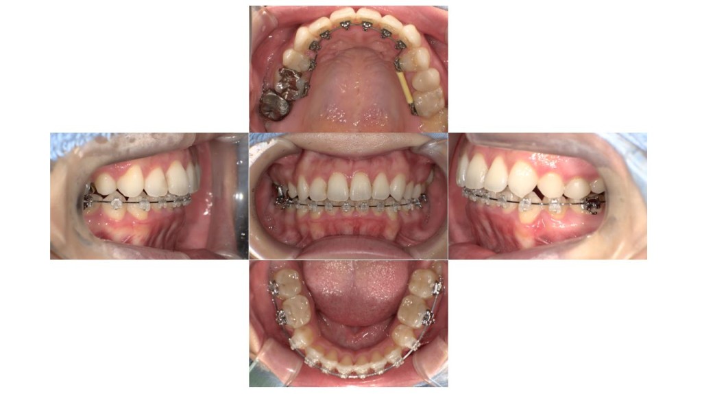 上の歯が出ている・ハーフリンガル矯正の症例