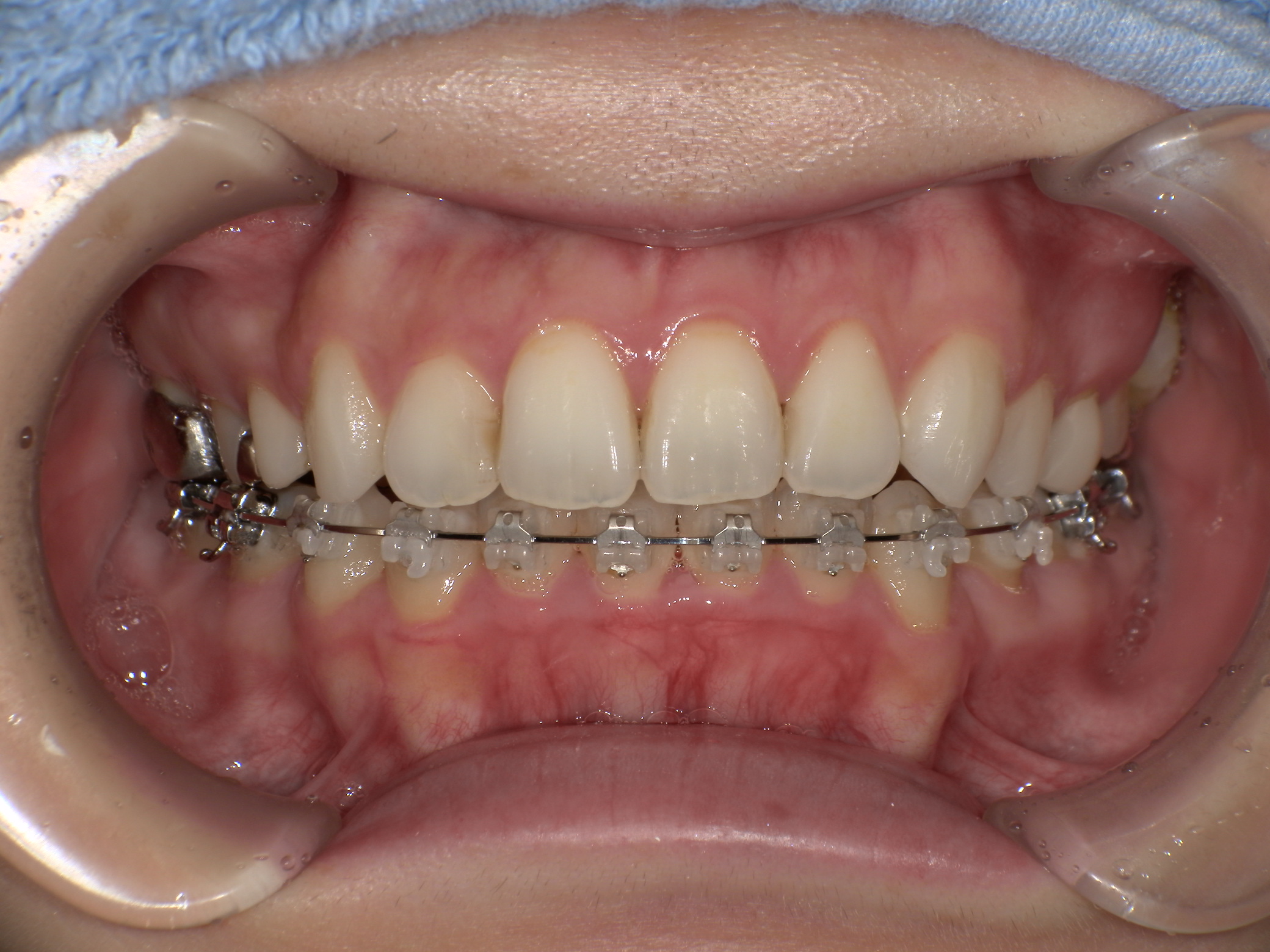 上の歯が出ている・ハーフリンガル矯正の症例