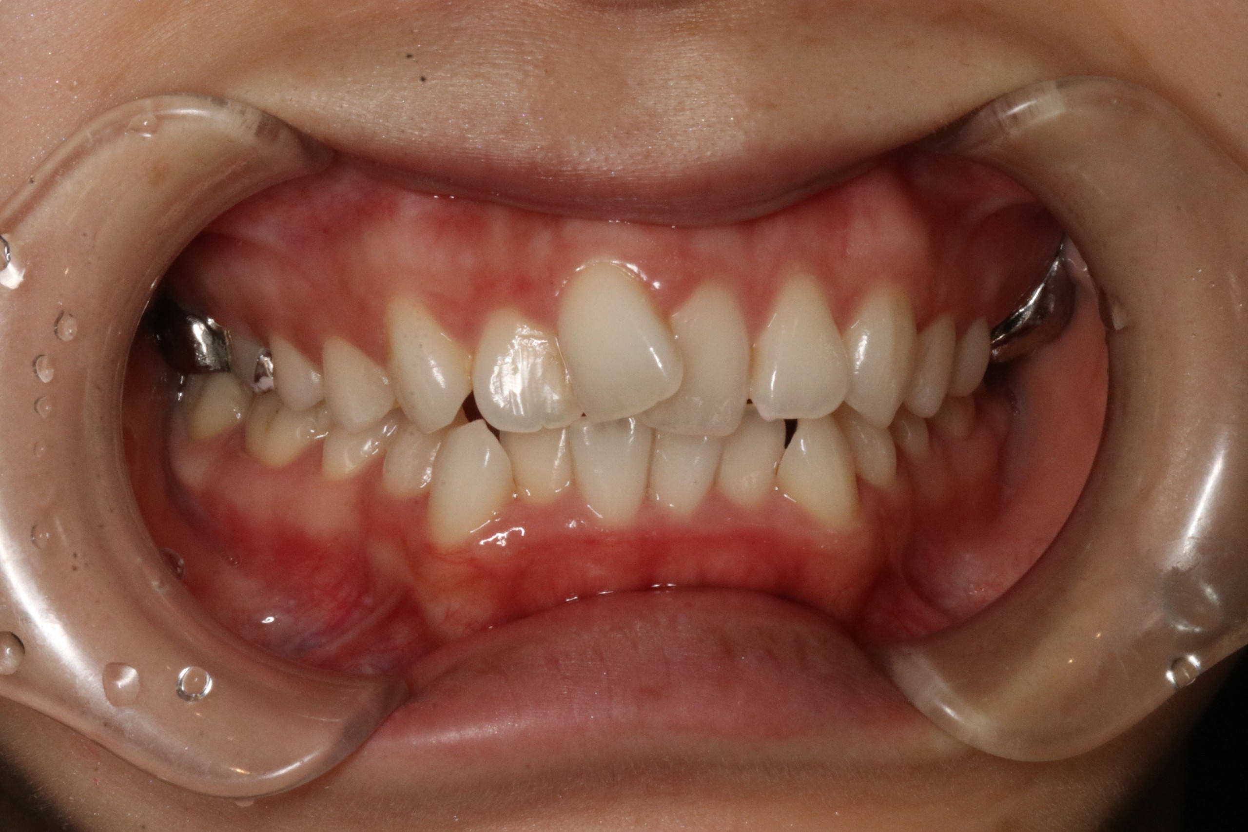 上の歯が出ている・ハーフリンガル矯正の症例