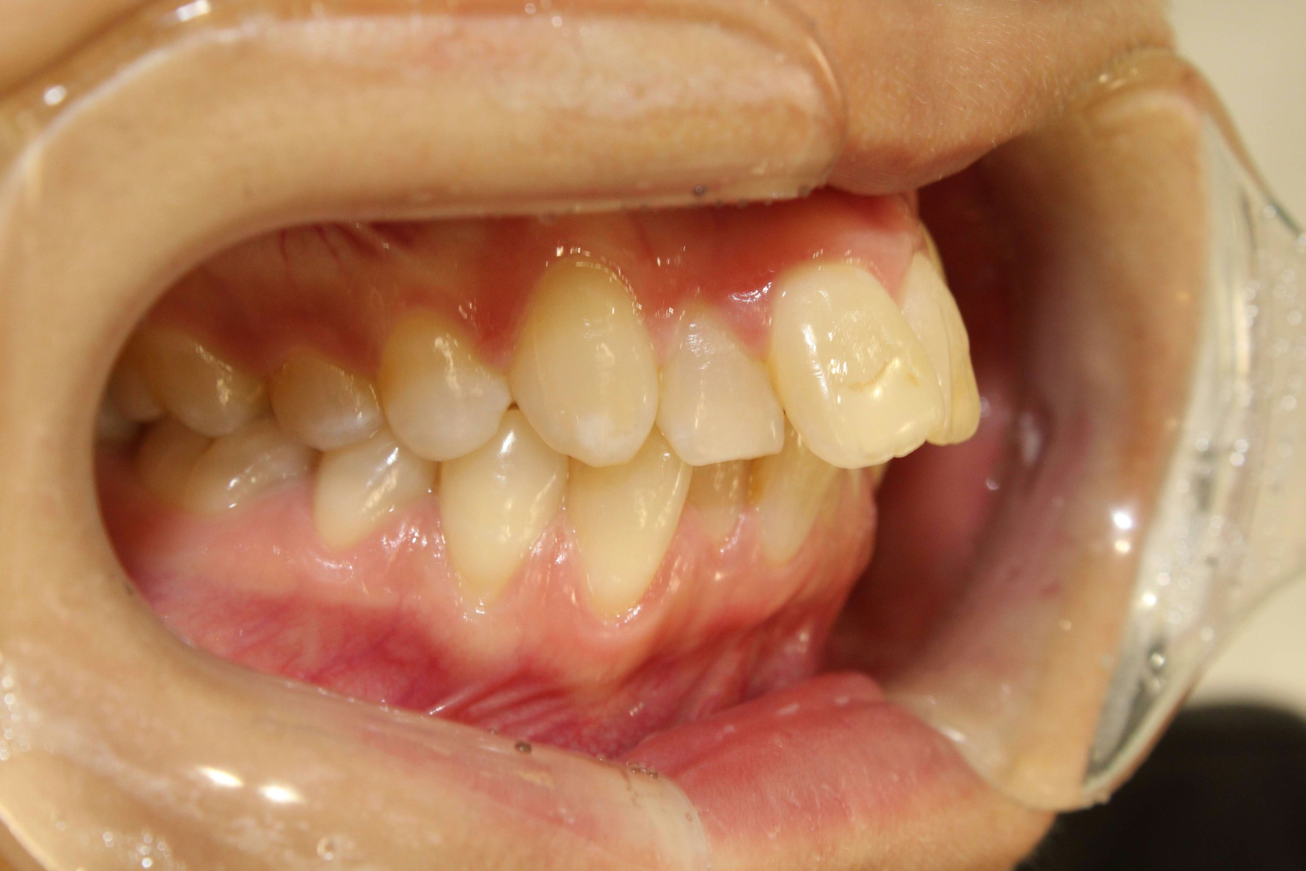 上の歯が出ている・リンガルの症例