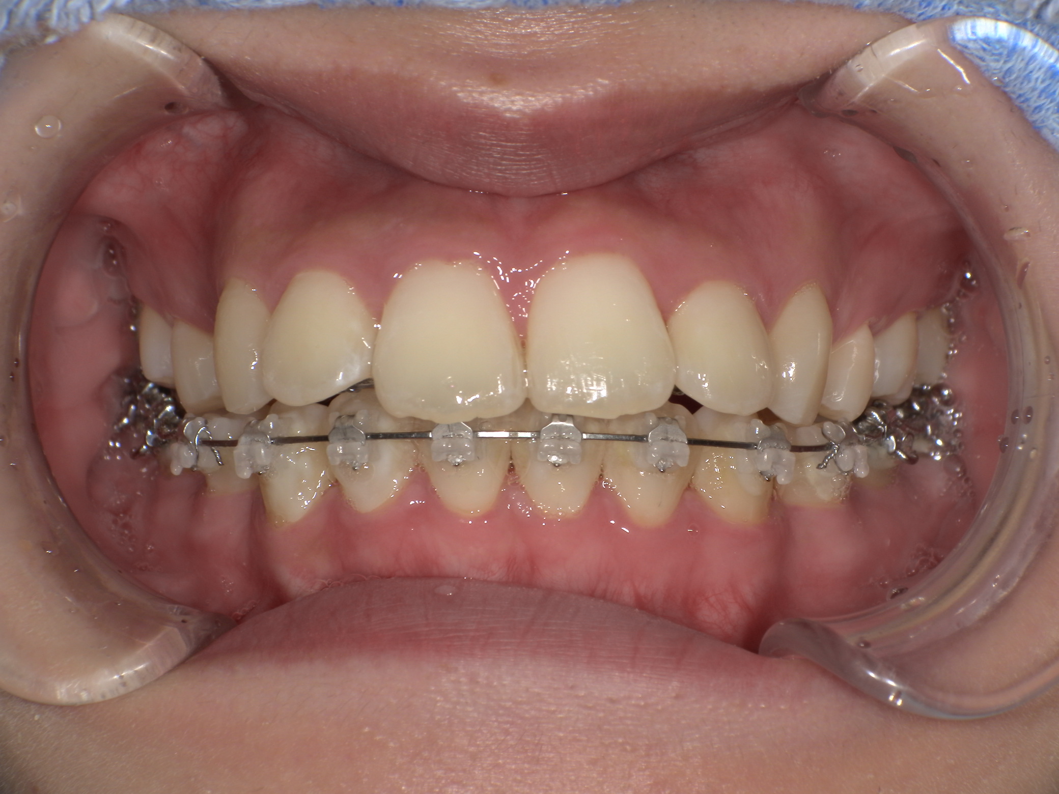 歯のでこぼこ・ハーフリンガルの症例