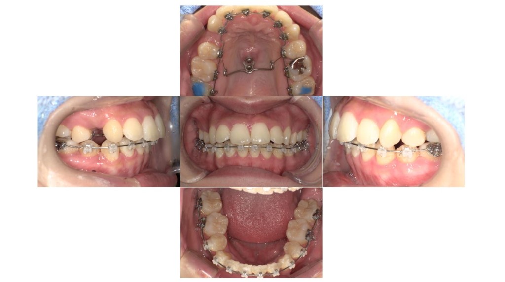 歯のでこぼこ・ハーフリンガルの症例