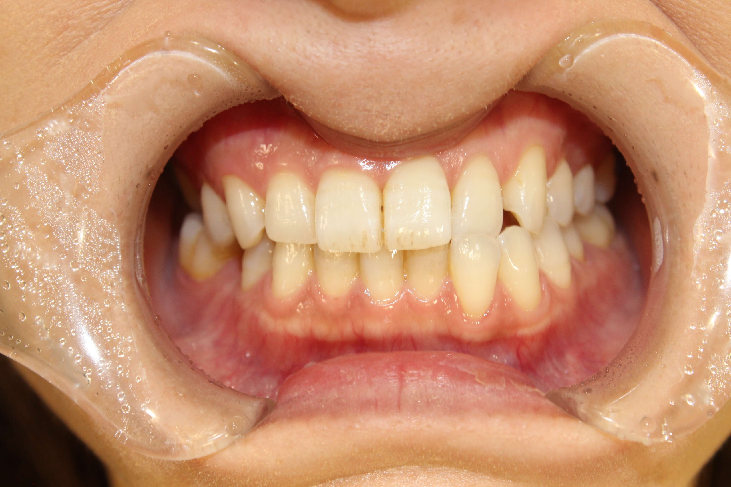 噛み合わせ・リンガルの症例