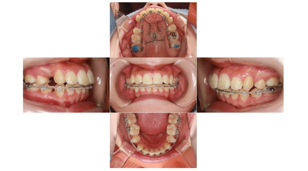 歯のでこぼこ・ハーフリンガルの症例