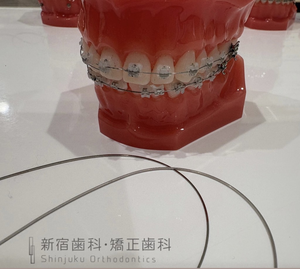 歯列矯正中にワイヤーが折れる原因について 矯正中にワイヤーが折れるって本当？