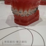 歯列矯正中にワイヤーが折れる原因について 矯正中にワイヤーが折れるって本当？