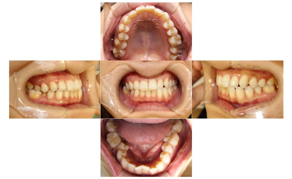 噛み合わせ・リンガルの症例