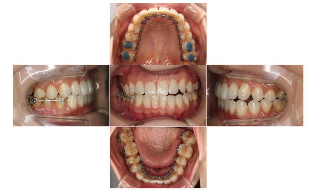 噛み合わせ・リンガルの症例