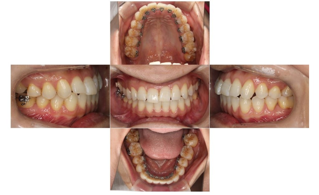 噛み合わせ・リンガルの症例