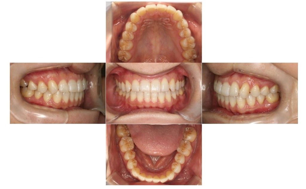 噛み合わせ・リンガルの症例