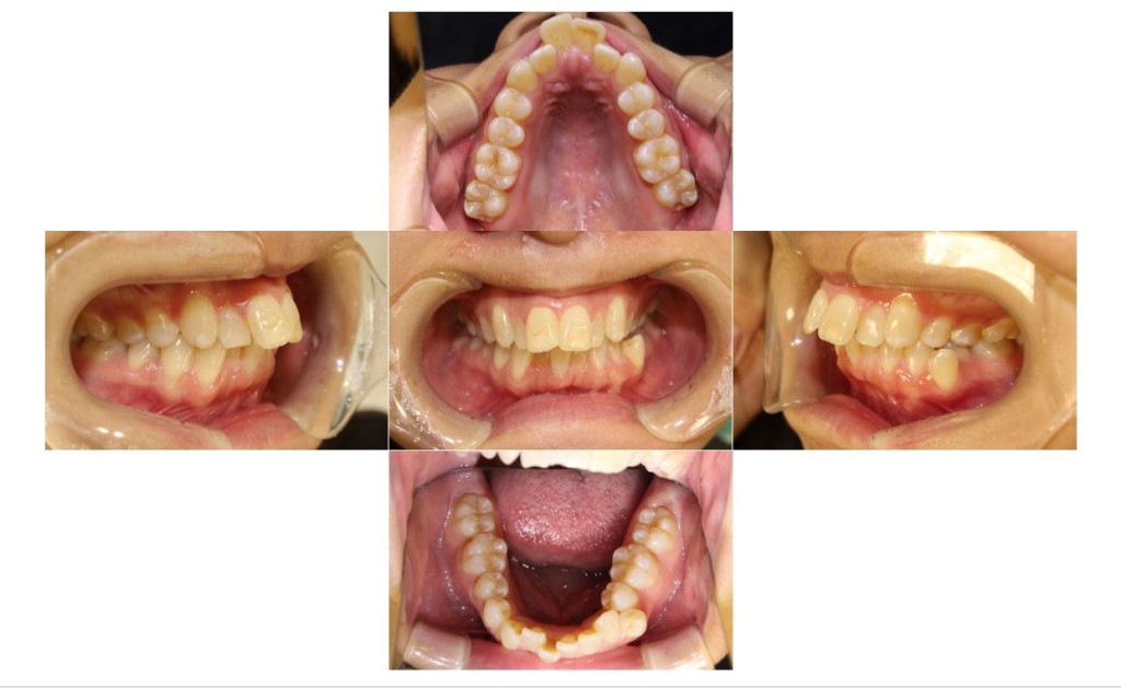 上の歯が出ている・リンガルの症例