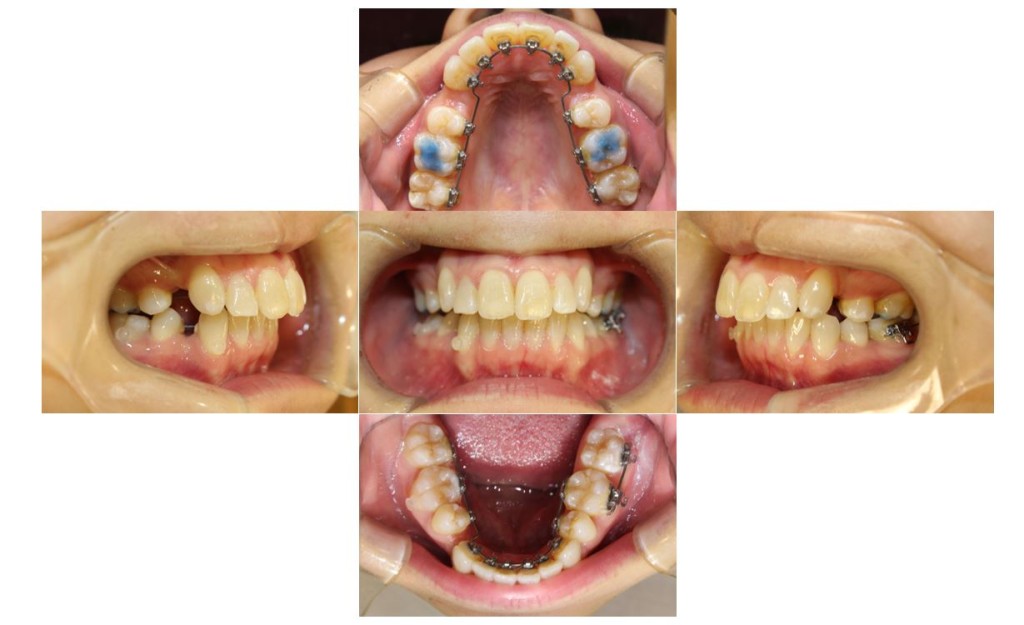 上の歯が出ている・リンガルの症例