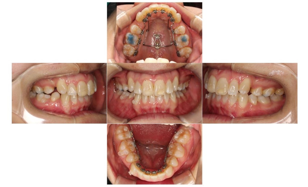 上の歯が出ている・リンガルの症例