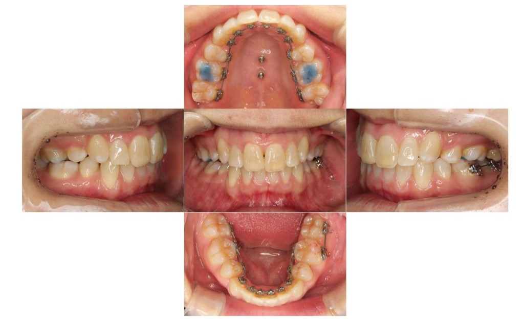 上の歯が出ている・リンガルの症例