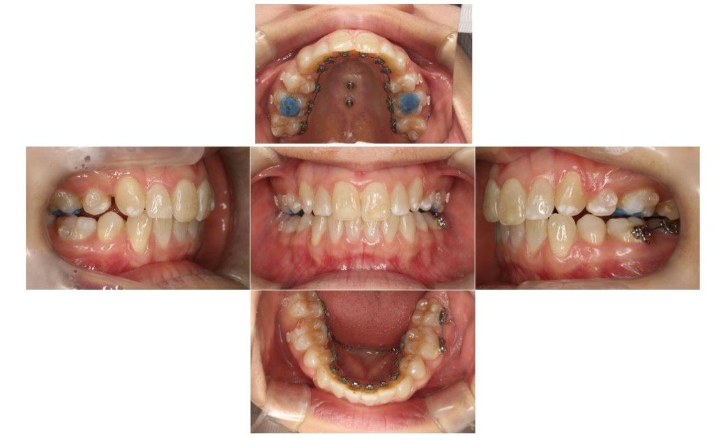 上の歯が出ている・リンガルの症例
