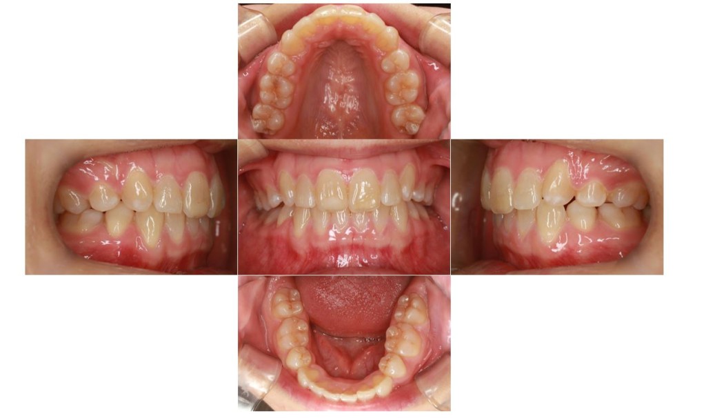 上の歯が出ている・リンガルの症例