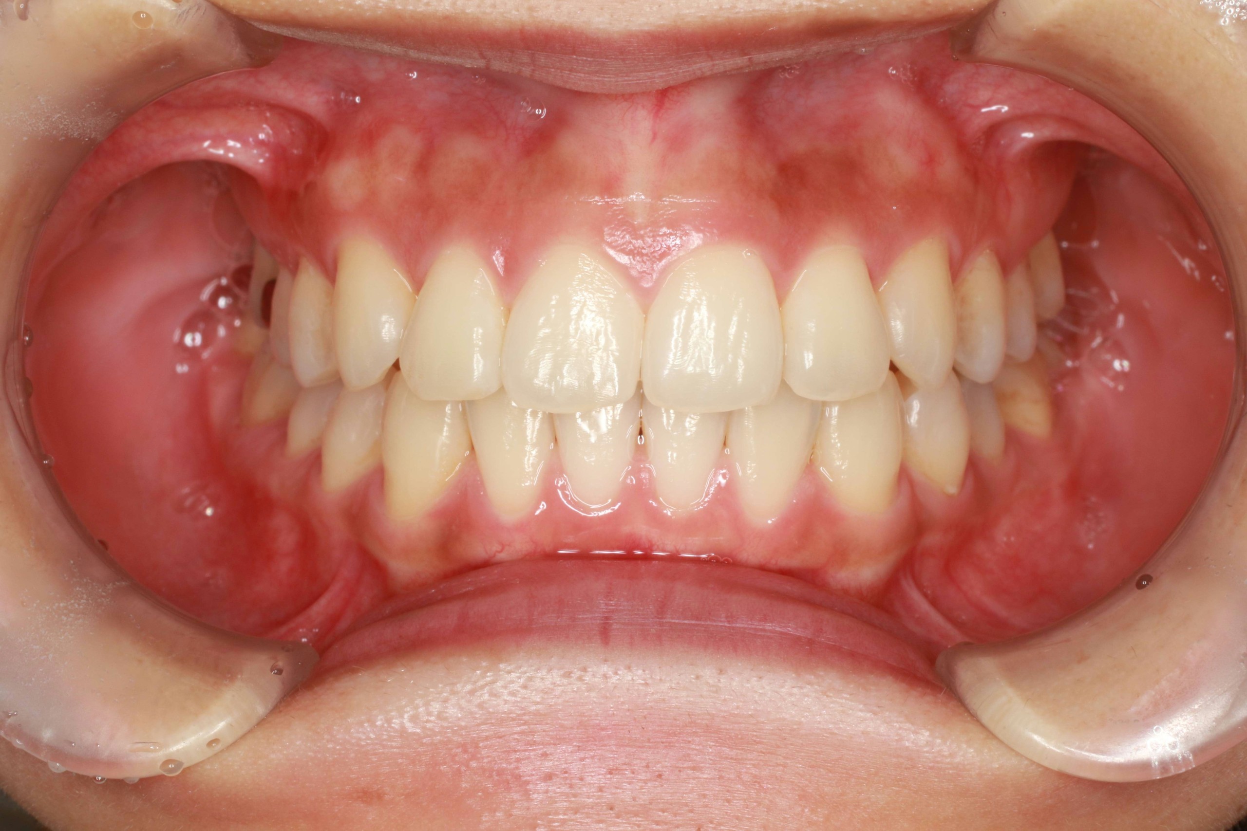 でこぼこ・噛み合わせが深いリンガルの症例