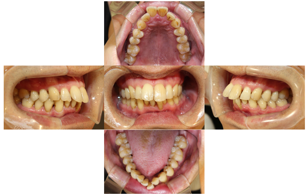 上の歯が出ている、裏側矯正の症例